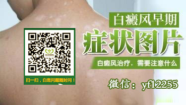 热无花果叶治疗白癜风有什么副作用吗 嘴唇的白癜风治疗了半年没好怎么办